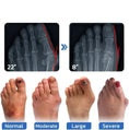 Load image into Gallery viewer, Anti-Bunion & Vein Health Socks for Women & Men
